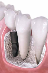 Dental implant image used by Costa Rica Medical Tourism Magazine to illustrate the report. 
