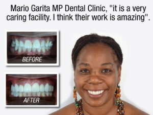 Crystal Allen about Mario Garita MP Dental implant prices testimonial - before and after