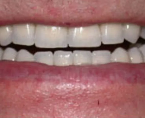 Natural-looking teeth