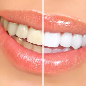 A restoration of natural tooth shade- It has become one the most requested procedures in cosmetic dentistry.