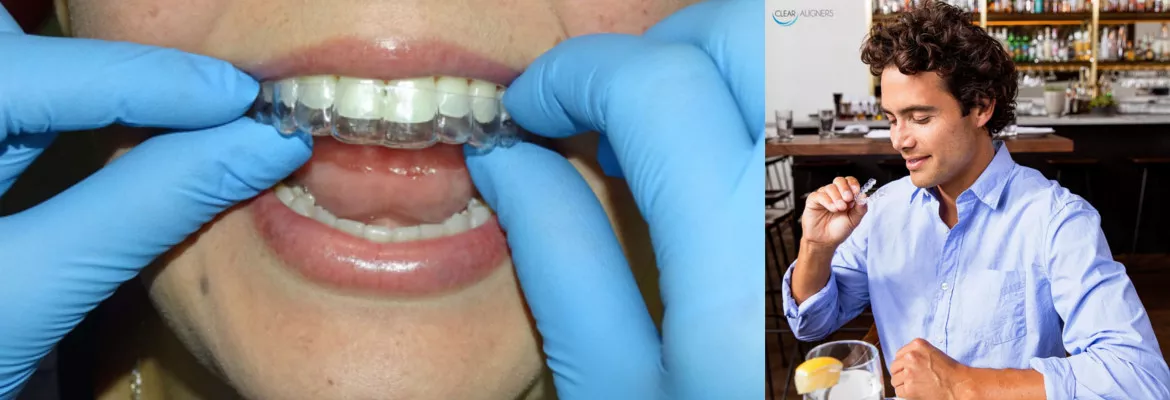 Real clear aligners adjusted at Mario Garita Dental Clinic in Costa Rica and a stock model image of how to use clear aligners