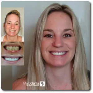 Porcelain veneers can protect chipped, cracked or damaged teeth while restoring their attractive, smooth aesthetic.