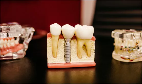 Illustrative image for dental implants made in Costa Rica