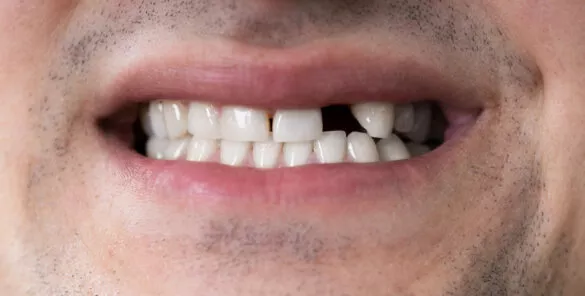 The Importance of Replacing Missing Teeth
