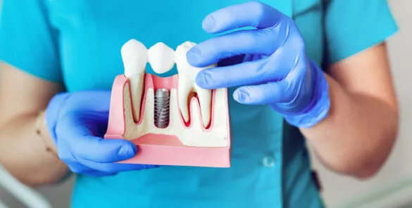 low cost full mouth dental implants MARIO GARITA Costa Rica